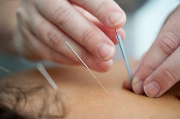 The Science Behind Acupuncture: How It Promotes Healing