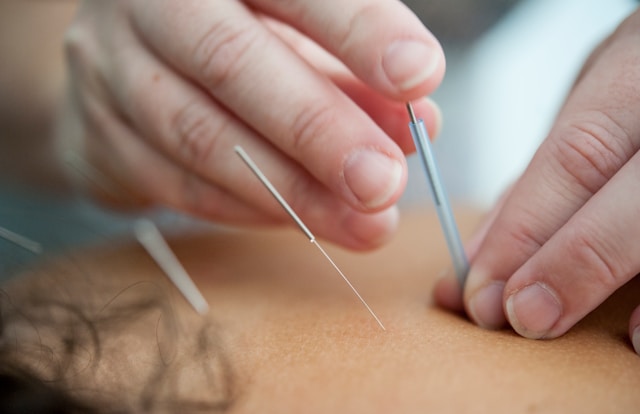 You are currently viewing The Science Behind Acupuncture: How It Promotes Healing